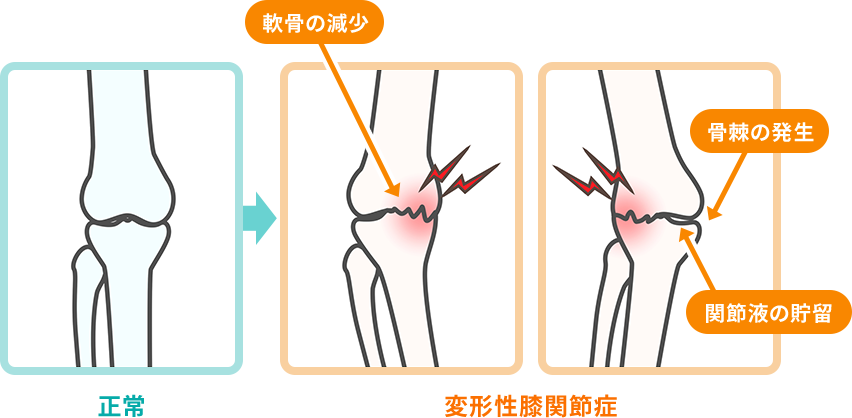 変形性膝関節症